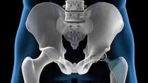 Hip with artificial joint.